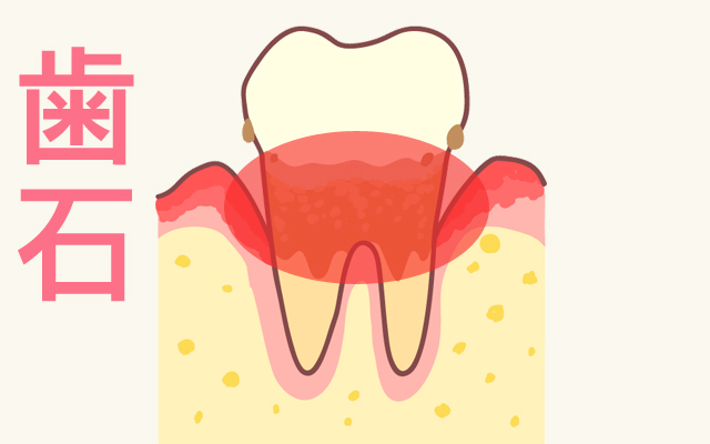 大きくなった歯石は歯と歯茎の間にも入り込みます